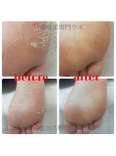 巻き爪専門ラボ 豊田店/タコ・魚の目・フットケア