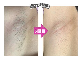 スキンエピ 札幌大通り店(Skinepi)/【両ワキ脱毛】で脱毛デビュー★