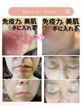ミラー(MIRAOR)/肌質細胞リセットBefore→After