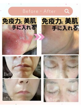 ミラー(MIRAOR)/肌質細胞リセットBefore→After
