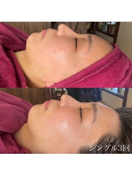 ハリーハリー 名古屋栄店(HARRY ハリー)/◆肌質改善◆