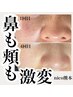 【超贅沢セット】毛穴洗浄＋デコルテマッサージ100分