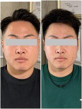 ペリー(PELLY)/アゴまわりをスッキリ