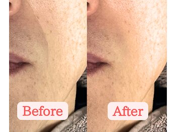 オアシス 船橋店(Oasis)/マイクロニードル施術手順４