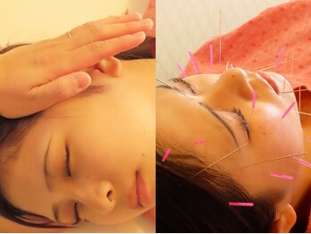 アイビソウ 所沢(IBISOU)の写真/人気鍼灸師とエステコラボ☆肌質改善と若々しい印象の美肌を同時に手に入れる！[美容鍼×極上フェイシャル]