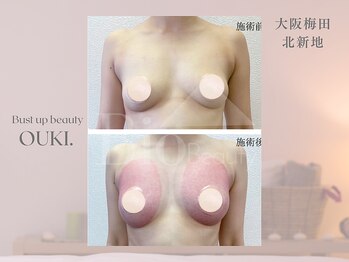 【育乳・バスト専門×女性らしさを磨く】OUKI. 梅田北新地【3月1日 OPEN（予定）】/バスト結果写真