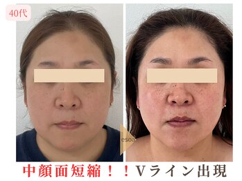 エソア(esoa)/40代 小顔矯正