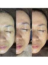 スタジオ オグラ(Studio-Ogura)/ピーリング３回イメージ３