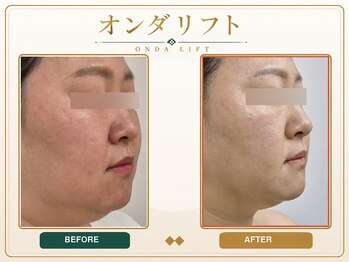 ジェムスキンラボ 所沢店(GEM SKIN LAB)の写真/《埼玉唯一のオンダリフト導入店★》若い頃と違うもたつき・二重アゴに！とにかく小顔になりたい方向け！