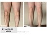 【新規メンズ脱毛】人気の清潔感ケア◎Lパーツ脱毛1回￥7,150→