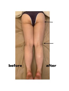 フラウラ(Fraula)/比較写真☆インディバケア