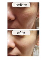 インスティンクトネイルズ(INSTINCT Nails)/フェイシャルエステ☆シミケア