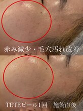 ヴィオール 名古屋栄店(VIOR)/オススメ　テテピール　毛穴改善