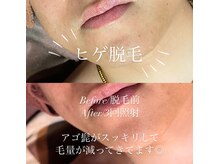 ビマナ 小岩店(NU美Mana)/ヒゲ脱毛