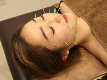 ソラナ(Solana)/美容鍼