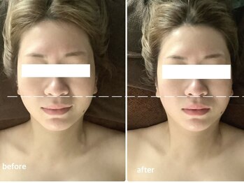 アベリア リュウ(Aberia Lieu)/頭蓋小顔矯正/小顔矯正