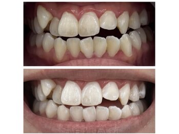 エクシア ホワイトニング 伊勢崎店/