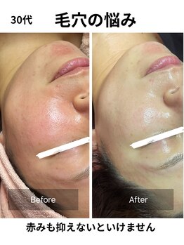 ヒール(heal)/毛穴の悩み　