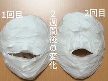 ルアナ(Luana)/2週間の変化　小顔ヘッドスパ