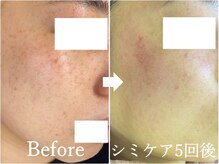 ニコ アンド キャンディー(Nico.&Candy)/本気でシミ改善したい方募集中