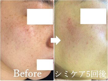 ニコ アンド キャンディー(Nico.&Candy)/本気でシミ改善したい方募集中