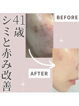 エステティック エイチアンドビー 大和店(H&B)/シミケア　フェイシャル