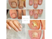 デイジーネイル(Daisy Nail)