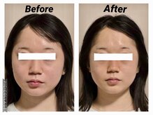 ショウフェイスデザイン(Sho Face Design)/《小顔矯正》ビフォーアフター