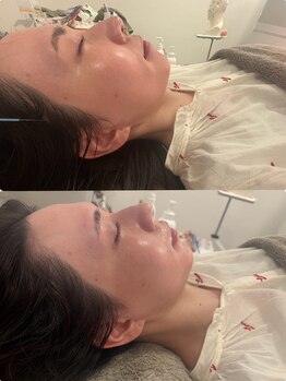 マホロバ(mahoroba)/ダーマ鍼