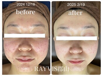 レイビス 郡山店(RAYVIS)/ハーブピーリング