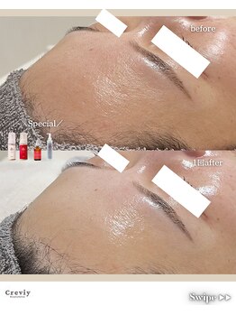 クレヴィー(Creviy)/陶肌ピール