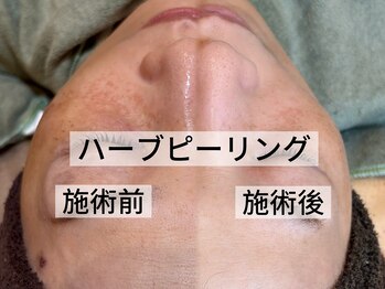 ジャドール ネイルアンドアイラッシュ(J'ADORE)/ハーブ　ビフォーアフター