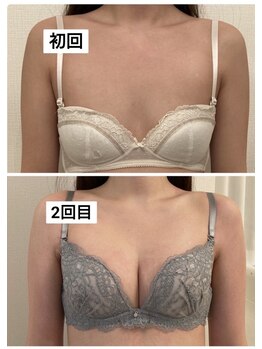 美人バスト 新宿店/☆姉妹店バストアップ症例写真☆
