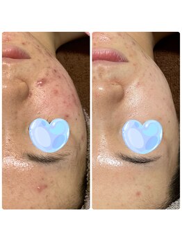 エムリシェ(M.riche)/ハーブピーリング