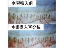 アドレ(ADORE)/水素吸入30分後