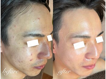 プライベートサロン コットン(COTTON)/肌改善プログラム