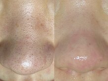 ダリア(Dahlia)/毛穴エクストラクション