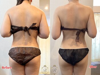 ルフレ(REFLET)/【事例7】Before/After/痩身