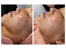 ムーン 高崎店(MOON)/小顔フェイシャル