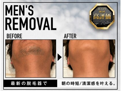 Aphro HOMME　キッズ.Men's髭脱毛/美肌/シミ/シワ/黒ずみの写真