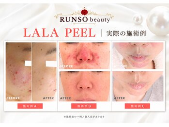 ランソ ビューティー 成田(RUNSO Beauty)の写真/《成田駅徒歩3分》ララピールでつるんと艶肌へ◎毛穴・くすみ・乾燥など肌悩みをまとめてケア