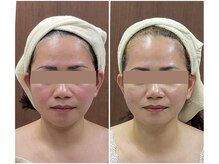 メイス 福井店(MEIS)の雰囲気（【小顔】before(1回目)after(3回目)）