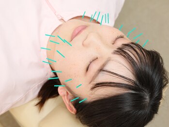むさし鍼灸整骨院 大宮院/美容鍼コースでお顔スッキリ☆★