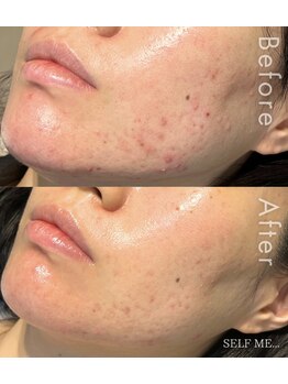 セルフミー 恵比寿(SELF Me...)/ハーブピーリング/ニキビケア