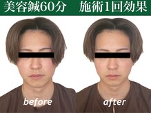 もみの木鍼灸整骨院 恵比寿/初回のみ美容鍼ビフォーアフター