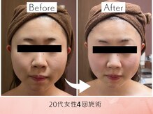 ラグーン(Lagoon)/WINBACK×小顔矯正コルギ