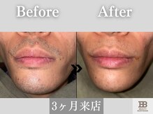 ビューティーアンドボディメイクBB シャオ西尾店/ヒゲ脱毛でヒゲ剃り不要◎