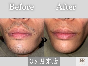 ビューティーアンドボディメイクBB シャオ西尾店/ヒゲ脱毛でヒゲ剃り不要◎