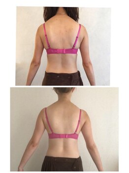 ソラ(SORA)/バストアップ症例