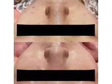 ダイエットステーション 仙台東口店/毛穴洗浄フェイシャル